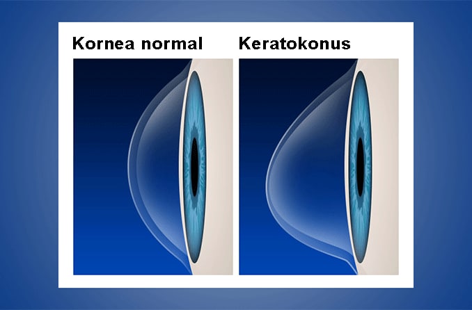 10 pengobatan keratokonus-plus penyebab, gejala