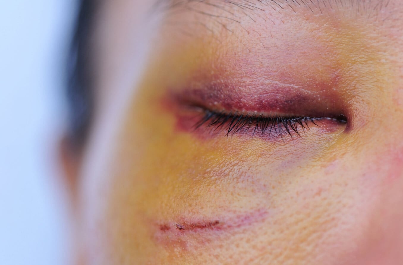 Tổn thương mắt: Điều trị chấn thương mắt | All About Vision