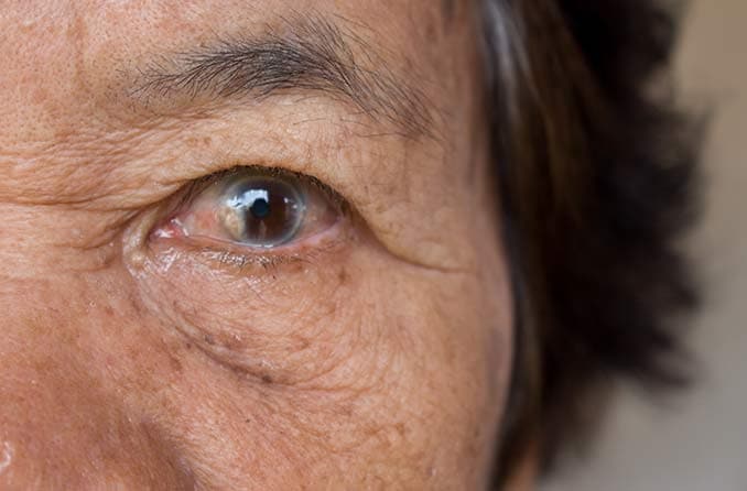 Biến chứng sau phẫu thuật đục thủy tinh thể | All About Vision