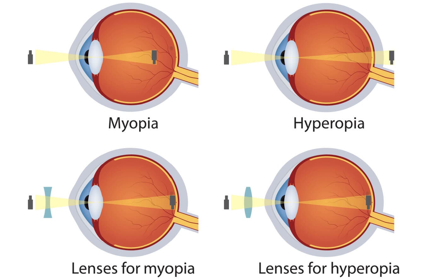 Myopia vs. hyperopia: What’s the difference?
