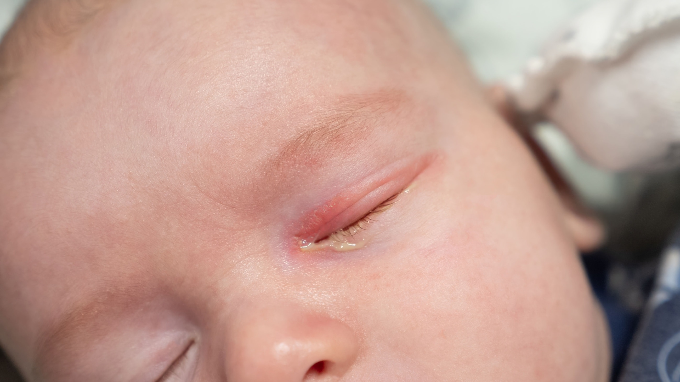 Clogged tear ducts in a baby: Causes, symptoms and treatment Clogged tear ducts in a baby: Causes, symptoms and treatment