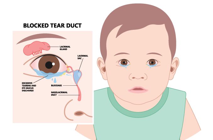 Clogged tear ducts in a baby: Causes, symptoms and treatment