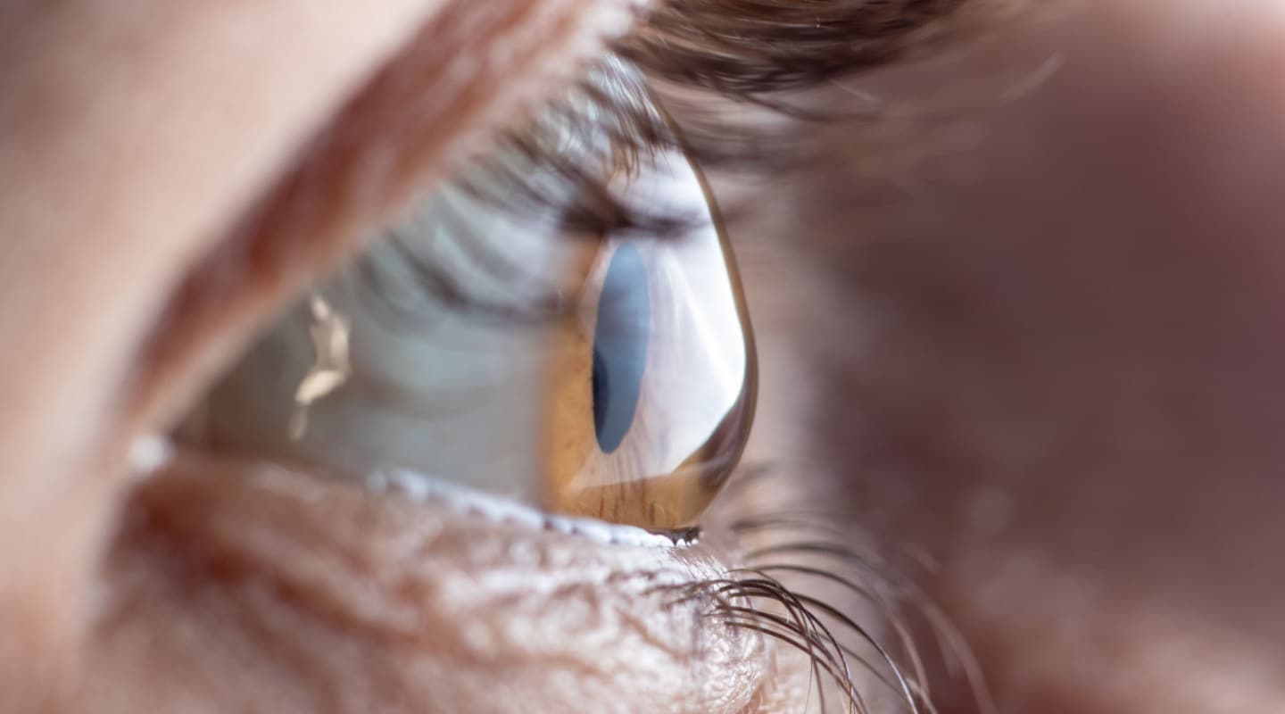 Upclose image of and eye with keratoconus