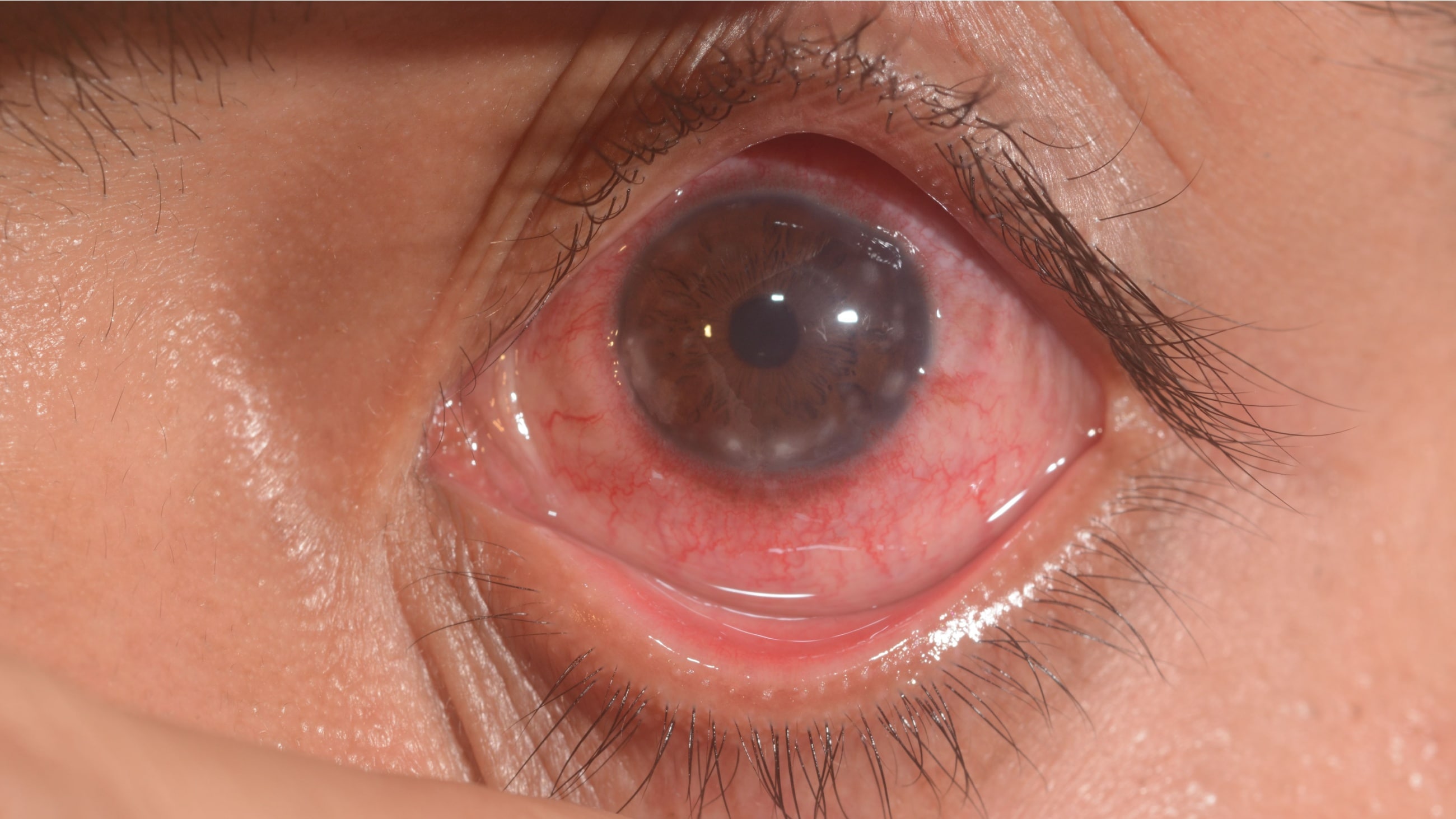 Atopic Keratoconjunctivitis Atopic Keratoconjunctivitis