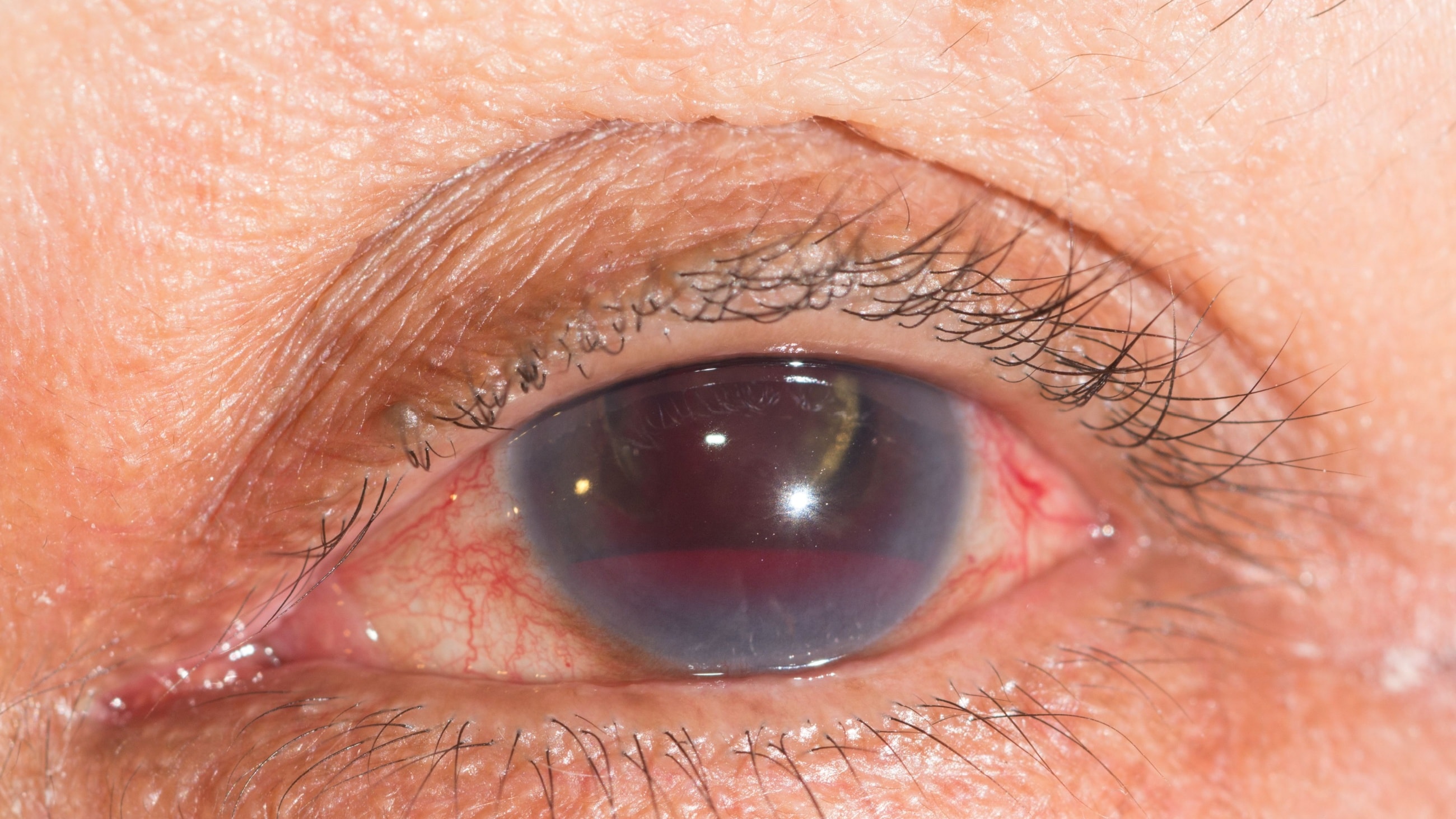 Hyphema Hyphema