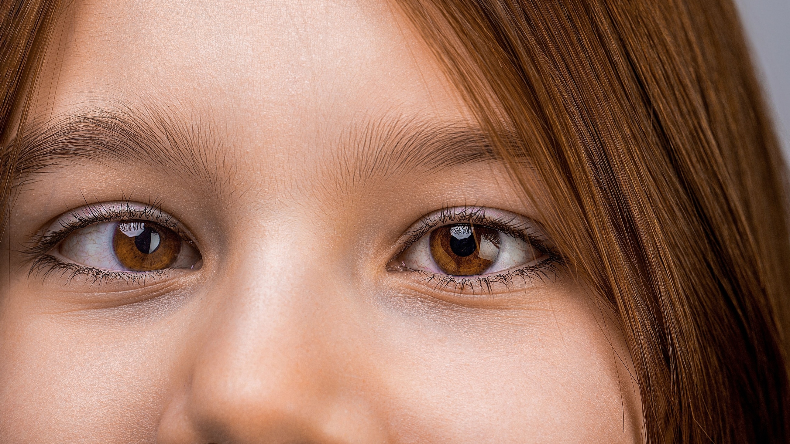Young girl with strabismus Young girl with strabismus