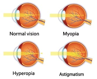 Ametropia: Description, prevalence and treatment