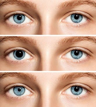 Anisocoria: What causes unequal pupil sizes?