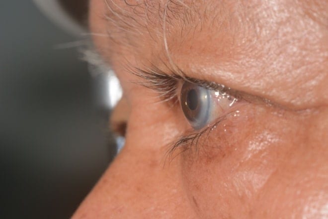 Arcus senilis (corneal arcus) Arcus senilis (corneal arcus)