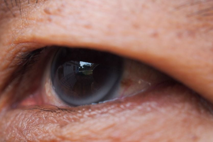 Arcus senilis (corneal arcus)