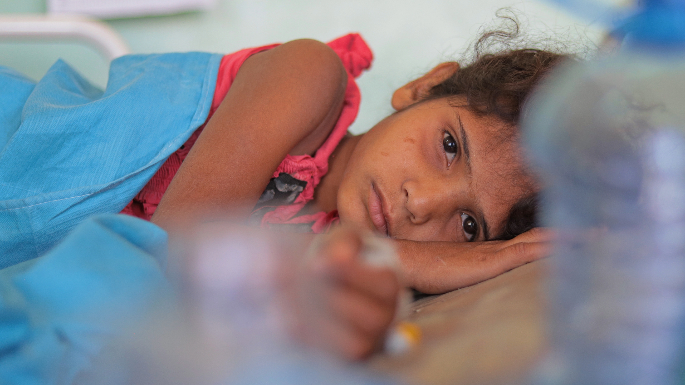 malnourished girl with vitamin A deficiency and bitot spots in her eyes