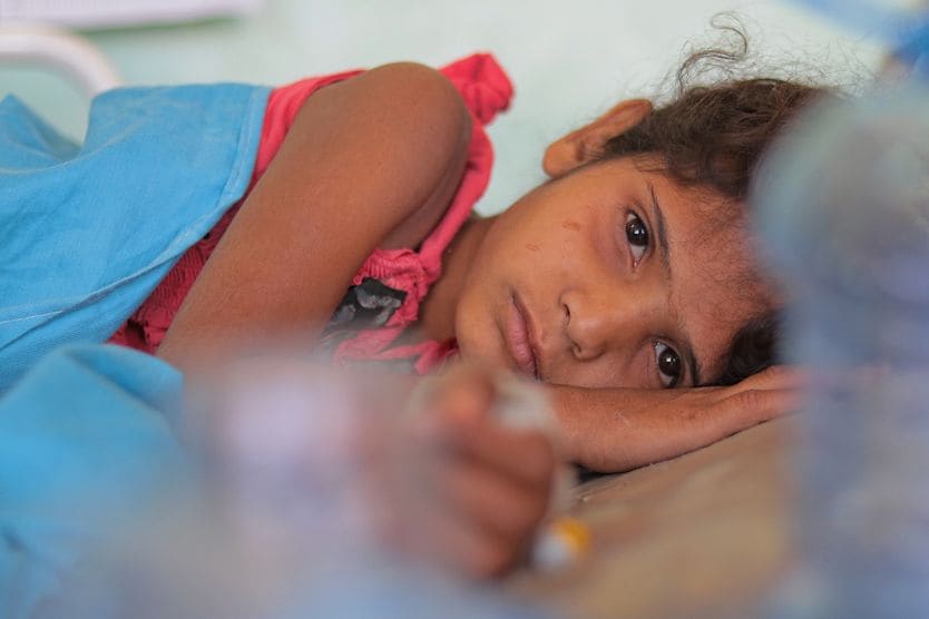 Bitot spots malnourished girl with vitamin A deficiency and bitot spots in her eyes