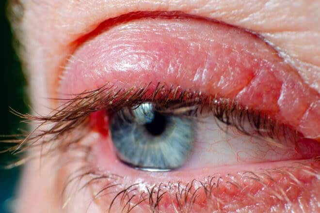 What is blepharitis? What is blepharitis?