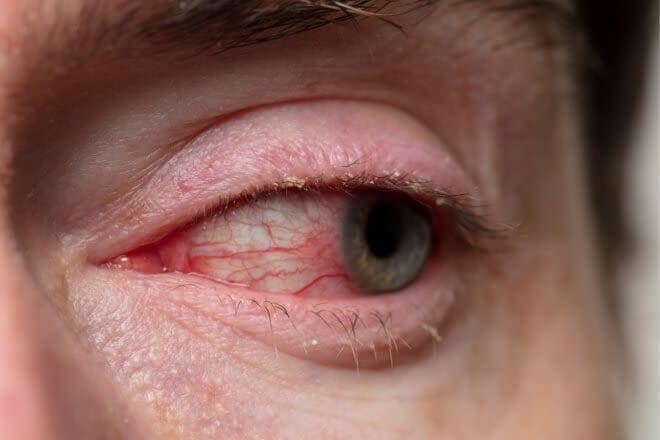What is blepharitis? What is blepharitis?