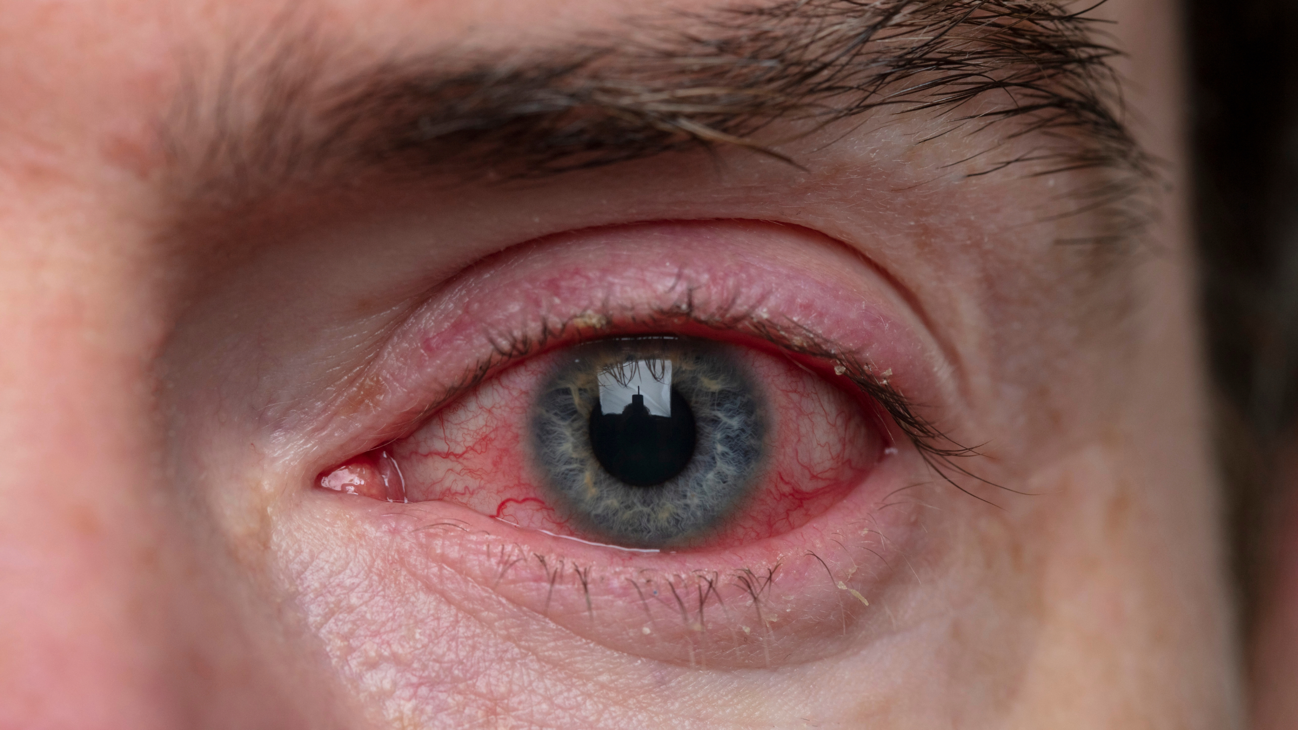 man with swollen eyelid / blepharitis
