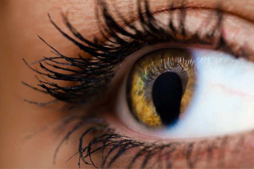 closeup image of an eye with cat-eye syndrome