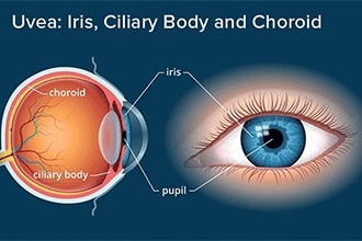 Chorioretinitis: Symptoms, diagnosis and treatment Chorioretinitis: Symptoms, diagnosis and treatment