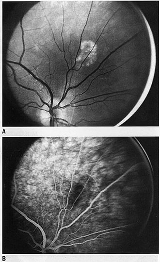 Choroidal nevus: A hidden “freckle” in the eye