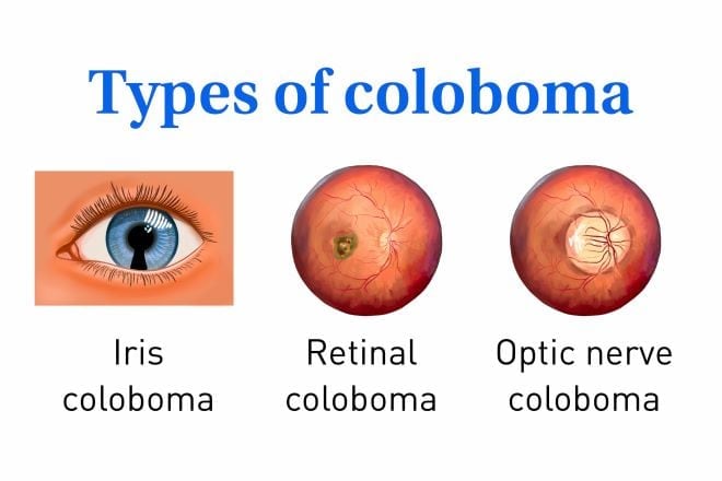 Coloboma