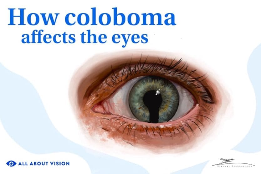 Child with Coloboma.