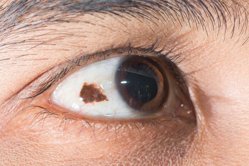 closeup of an eye with a conjunctival nevus