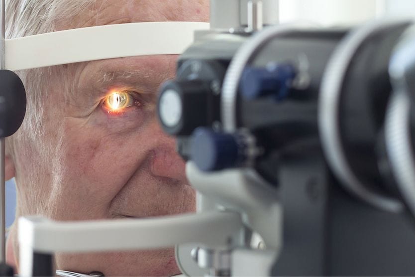 Conjunctivochalasis Eye doctor performing slit lamp exam on older man in order to detect conjunctivochalasis