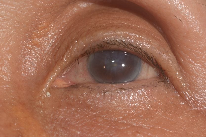 Corneal edema: Causes, symptoms and treatment closeup of an eye with corneal edema