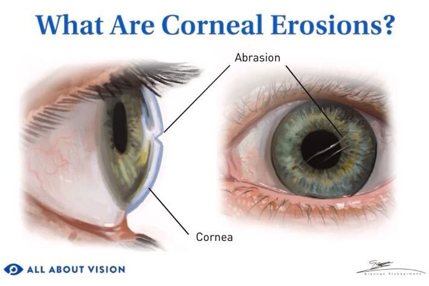A corneal erosion can be very painful and may lead to repeated episodes (called recurrent corneal erosions). Learn how they are treated and managed.