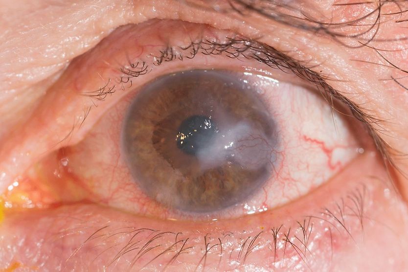 Corneal infiltrates: Causes, treatment and more close up of and eye with interstitial keratitis and corneal infiltrates during an eye exam