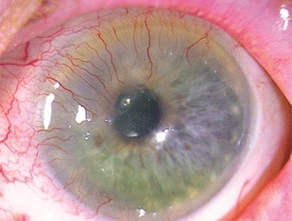 A guide to causes and treatment of corneal neovascularization