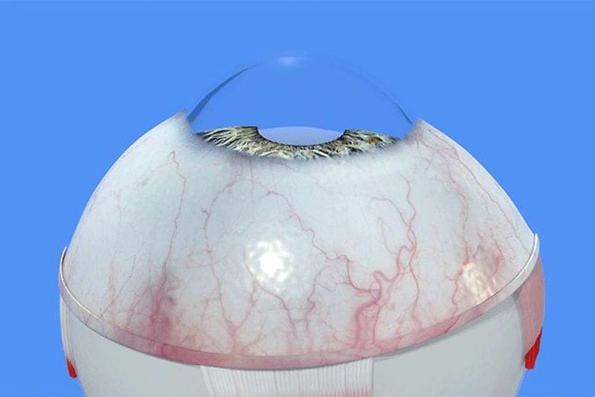 A guide to causes and treatment of corneal neovascularization 3D image of an eyeball displaying normal cornea without corneal neovascularization