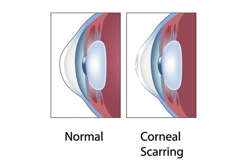 Corneal scarring: Causes, symptoms, treatment and healing time illustration of corneal scarring
