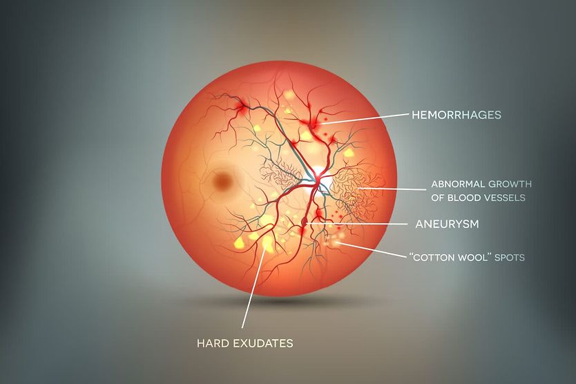 Cotton wool spots Diagram of a retina and cotton wool spots
