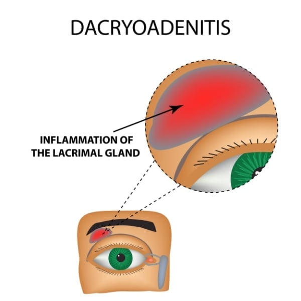 Dacryoadenitis