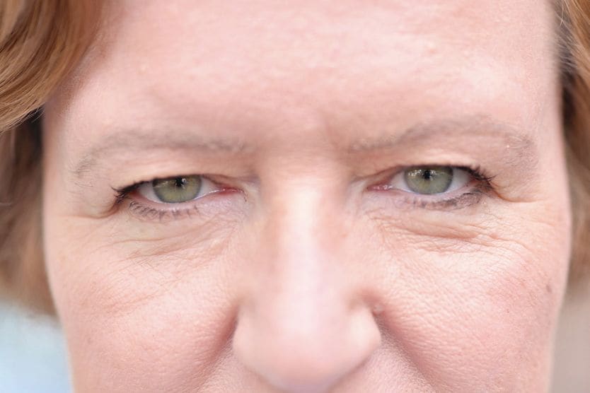Dermatochalasis woman with dermatochalasis