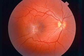 Epiretinal membrane (macular pucker)