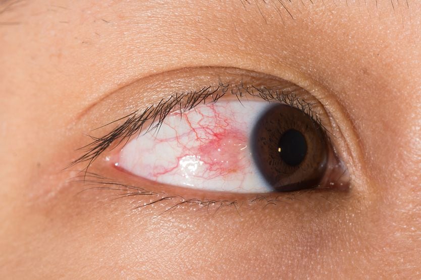 closeup of an eye with episcleritis