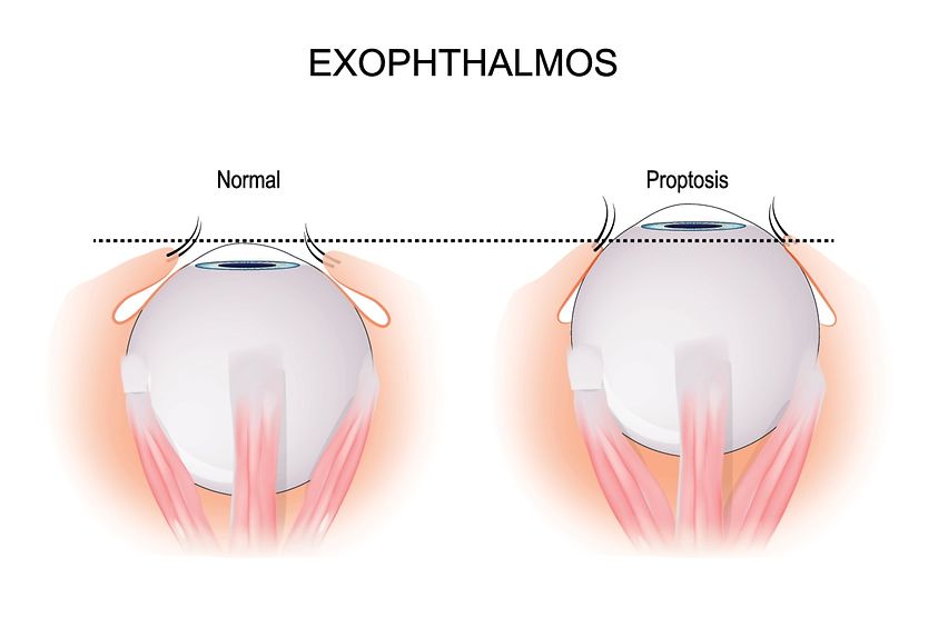 Exophthalmos (bulging eyes) illustration comparing a healthy eyeball vs. an eyeball with proptosis (exophthalmos)