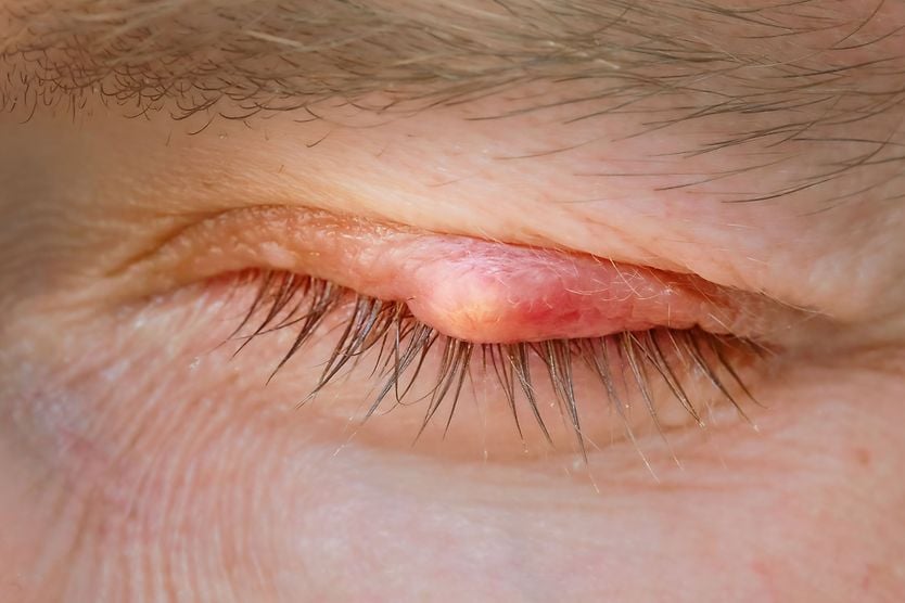 man with an eyelid cyst