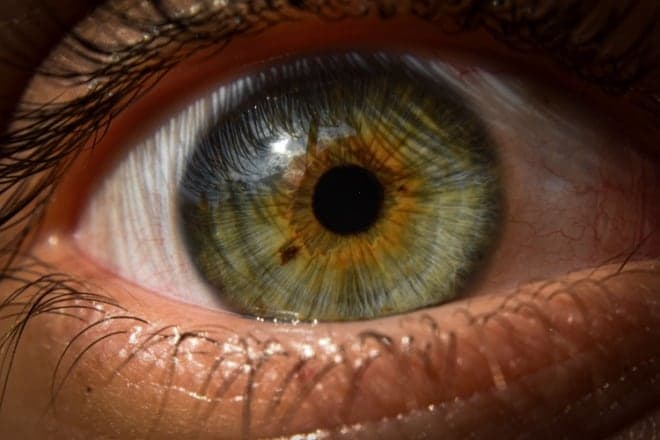 What does an eye freckle mean?