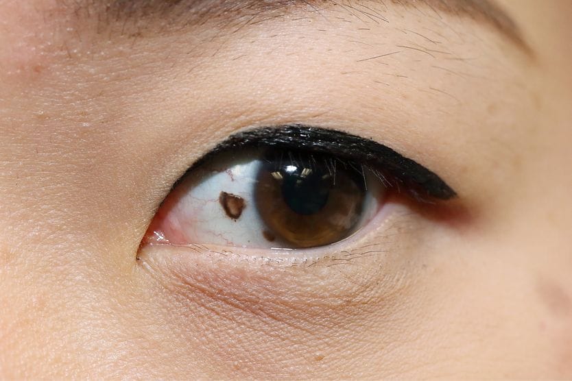closeup of an ocular nevus (eye freckle) on the sclera (white part of the eye)