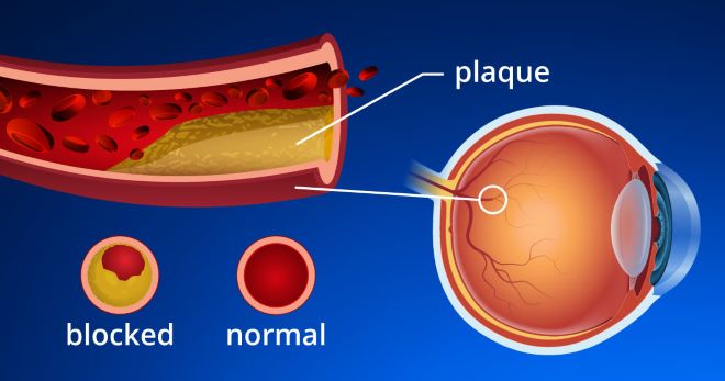 central retinal artery occlusion Eye doctor checking woman's eyes with light