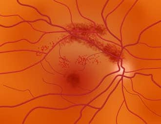 Eye strokes: CRAO, BRVO and other retinal artery and vein occlusions Eye strokes: CRAO, BRVO and other retinal artery and vein occlusions