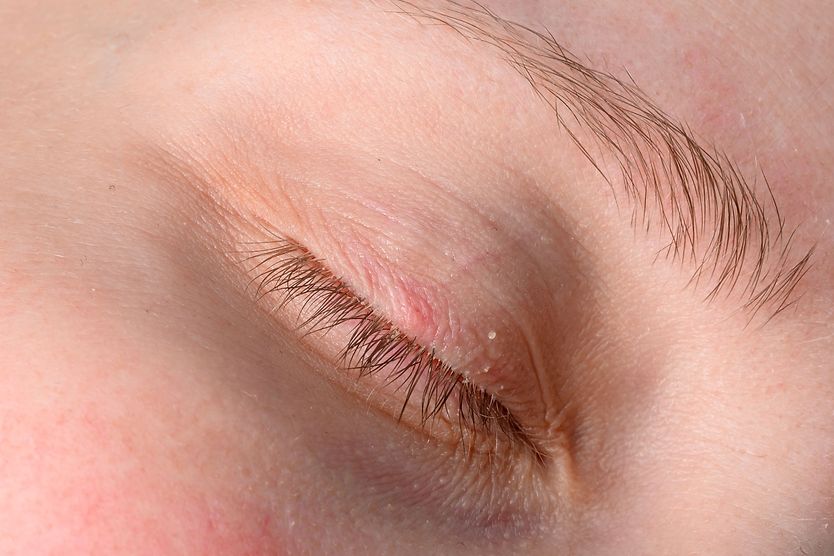 image of eyelash with lice