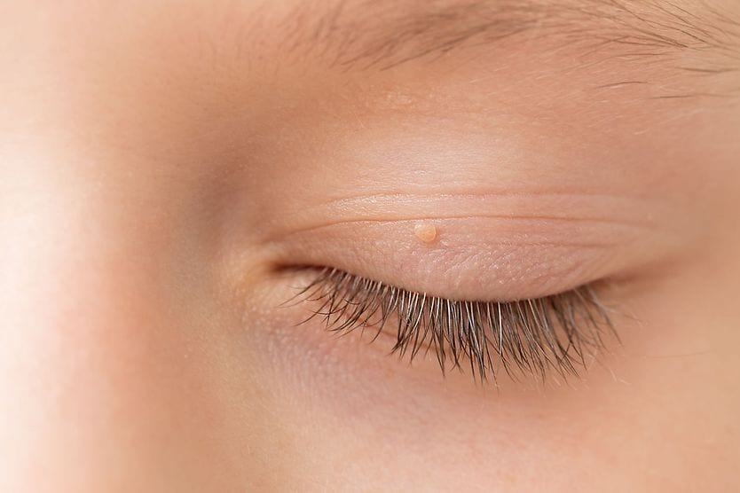 young child with eyelid papilloma