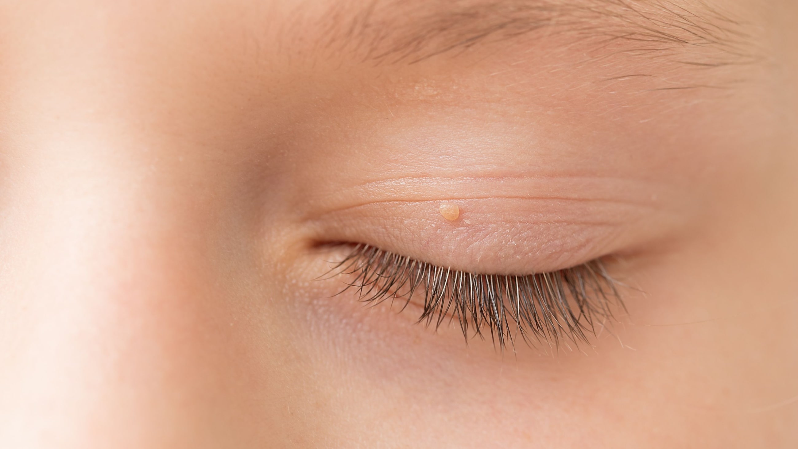Eyelid papilloma types, symptoms and treatments
