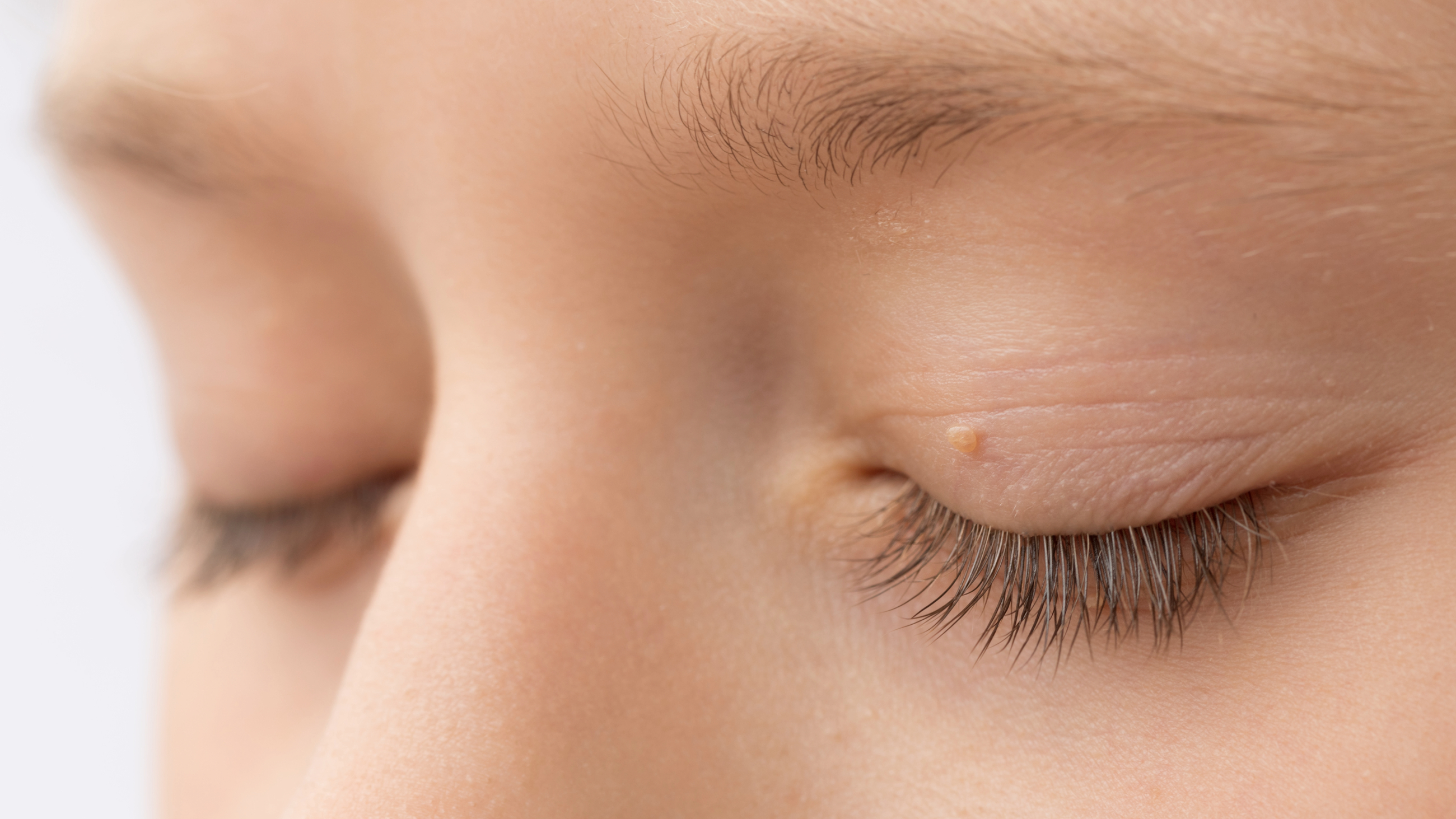 closeup of an eyelid skin tag