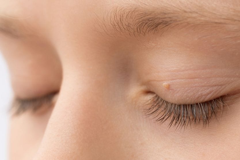 closeup of an eyelid skin tag