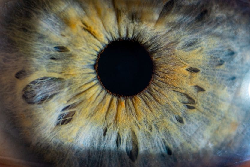 closeup of an eyeball with globe luxation