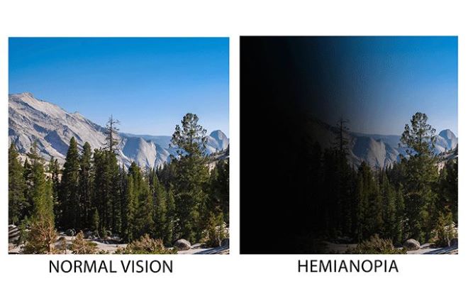 side by side mountainscape images of normal vision vs. vision with hemianopia image of road leading to a mountian with the left side blacked out